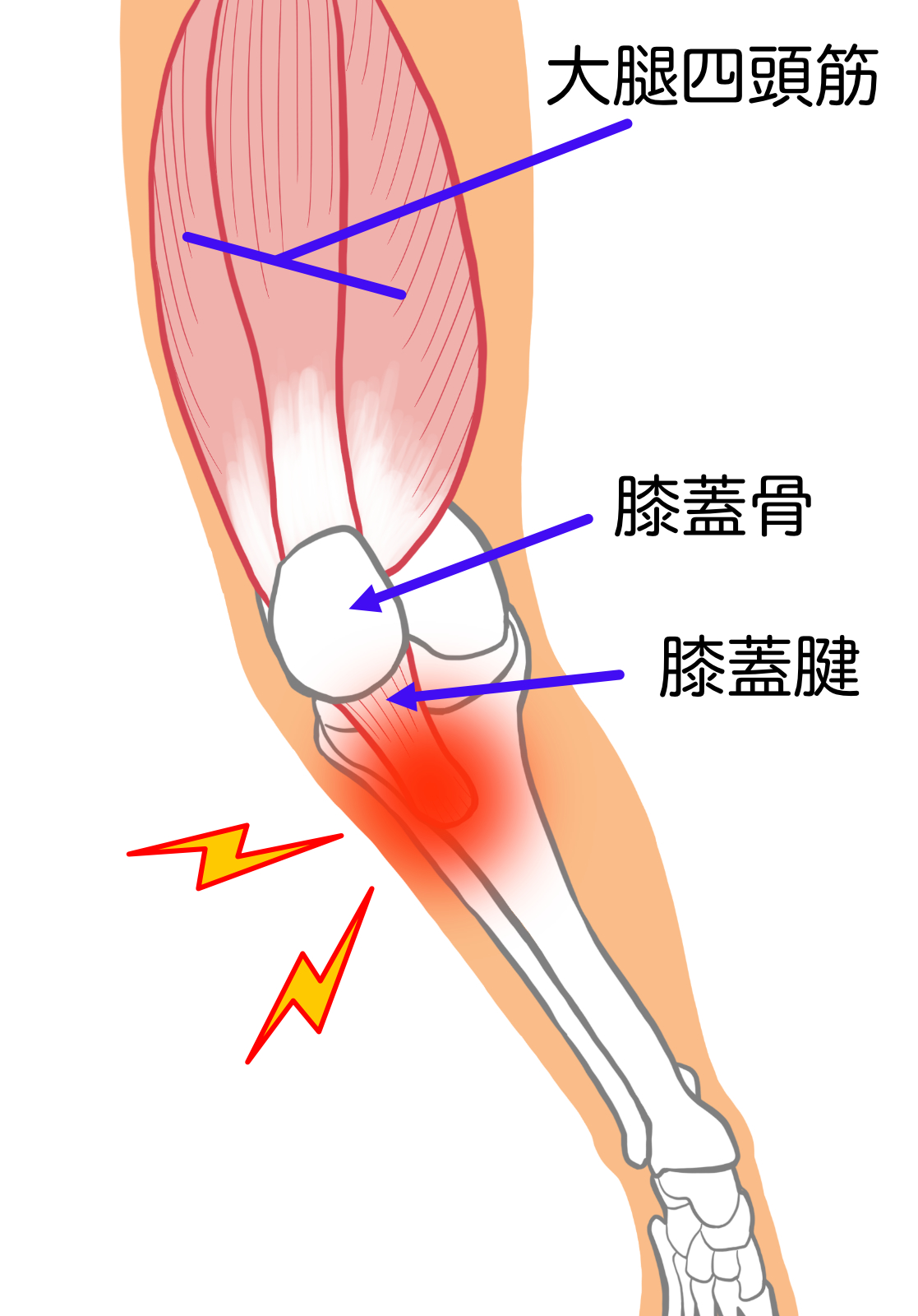 膝蓋腱炎(ジャンパー膝)の原因とは?マラソンで痛めた膝を鍼灸で改善