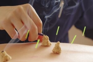 冬に悪化しやすい坐骨神経痛。冷え対策と鍼灸の温熱効果